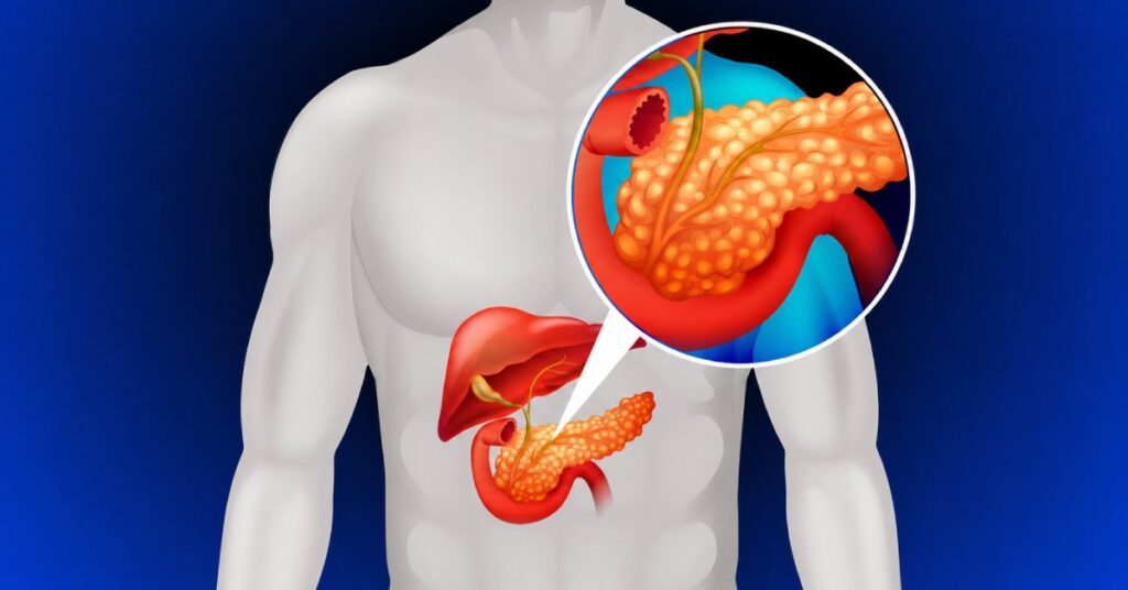 Cirurgia de cisto pancreático: quando é indicada e o que esperar do tratamento
